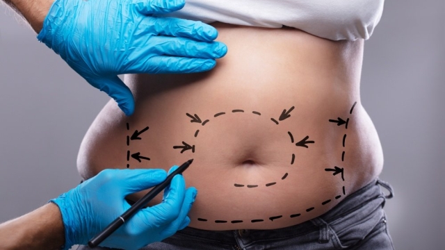 Flat Belly Dreams: The Ultimate Guide to Abdominoplasty