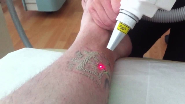 Tattoo Removal At Home – Things To Search For In At-Home Tattoo Removers