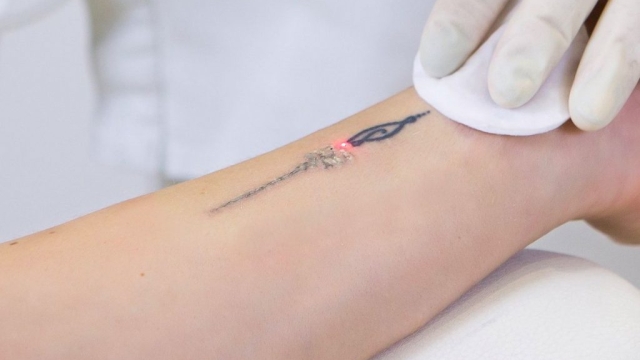 Types Of Tattoo Removal For Those Considering Tattoo Removal