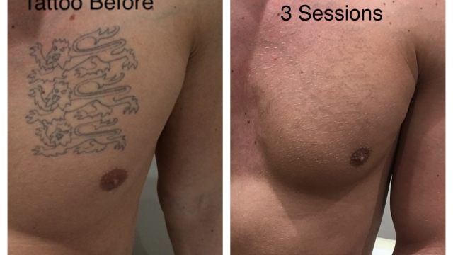 Tattoo Removal – Methods Of Your Unwanted Tattoo