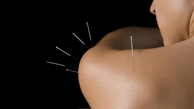 The Art of Needle Healing: Unveiling the Power of Acupuncture